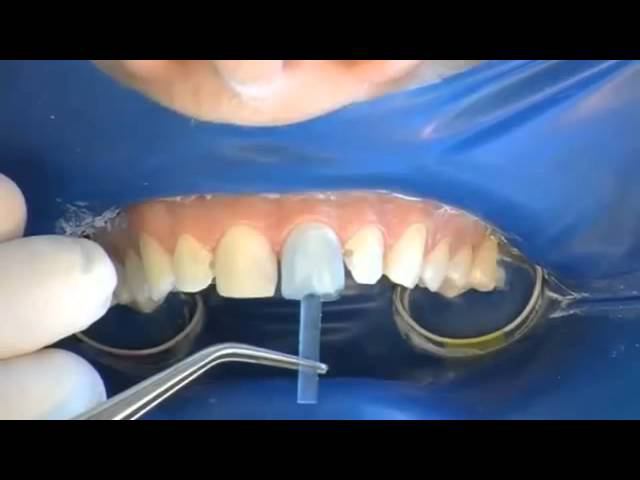 COMPONEER Direct Composite Veneering System   Short Version   RU