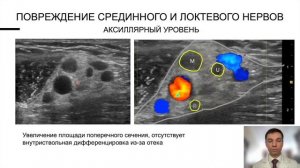 ПЛЕКСОПАТИЯ ПЛЕЧЕВОГО СПЛЕТЕНИЯ. УЗИ ДИАГНОСТИКА