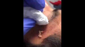 Popping huge blackheads and Pimple Popping - Best Pimple Popping Videos #2