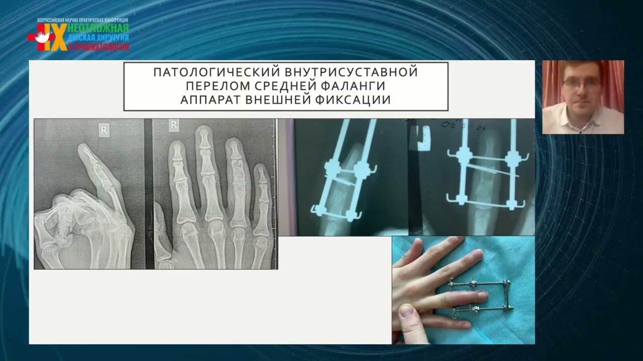 Травма суставов и костей конечностей: клиника и лечение