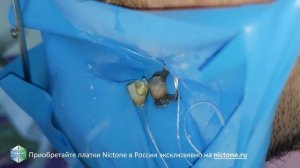 Инверсия платка Nictone флоссом при преэндодонтическом восстановлении 009 4K