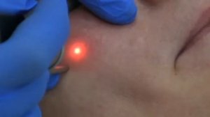 Удаление сосудов на лице лазером