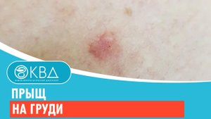 ? Прыщ на груди. Клинический случай №436