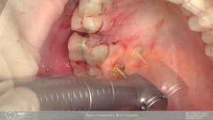 Установка имплантата Hi-Tec. Закрытый синус-лифтинг. Закрытие рецессии.