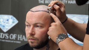 SASCHA'S HAIR TRANSPLANTATION JOURNEY / FROM UNITED KINGDOM