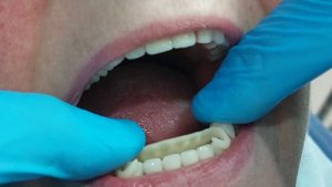 КВАДРОТТИ ПРОТЕЗ  ТИШЛАР !  СРОЧНО КУРИНГ ! МОСКВА +79636579707 ВАТСАП