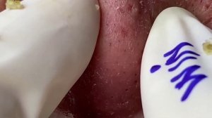 EXTRACTION OF BLACK DOTS. ВЫДАВЛИВАНИЕ ЧЕРНЫХ ТОЧЕК #чистота #косметология #уходзалицом