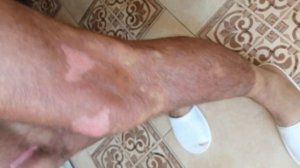 Жесть!!! Ожоги от борщевика. Чем лечил. Больно так что выть охото!!!