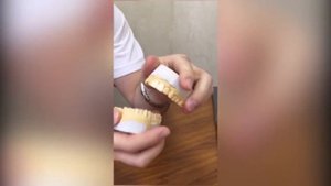 Что такое наращивание зубов