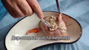 Дермоидная киста яичника