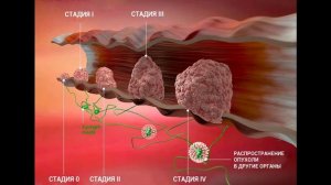 Что происходит на каждой стадии рака молочной железы? (подкаст)
