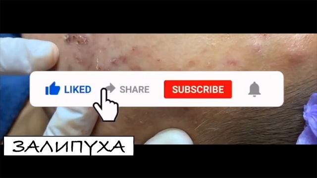 ВЫДАВЛИВАНИЕ ПРЫЩЕИ  ЛЕЧЕНИЕ АКНЕ НА ЛИЦЕ