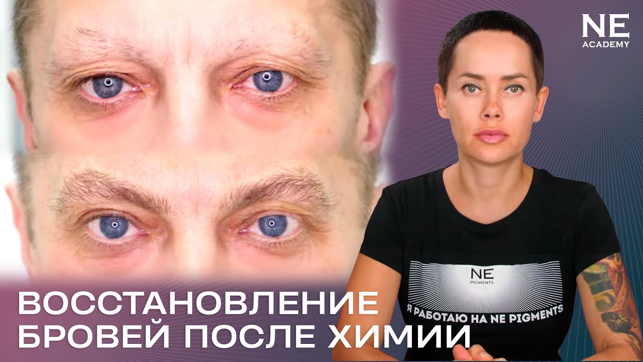 Восстановление бровей после химиотерапии.