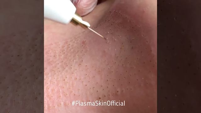 Аппарат PlasmaSkin. Коррекция морщин смотреть онлайн