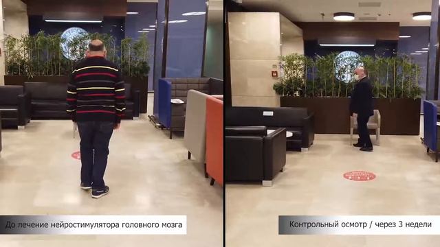 Изменения с Глубокой Стимуляцией Мозга болеющего болезнью Паркинсона пациента Газмэнда Зенелли смотреть онлайн