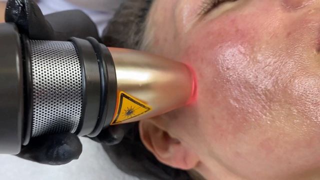 Лазерная биоревитализация в Beuty Science смотреть онлайн