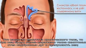 Как бороться с фронтитом