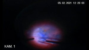 Витрэктомия 27G с удалением эпиретинальной мембраны