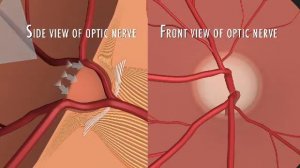 Зрительный нерв при глаукоме