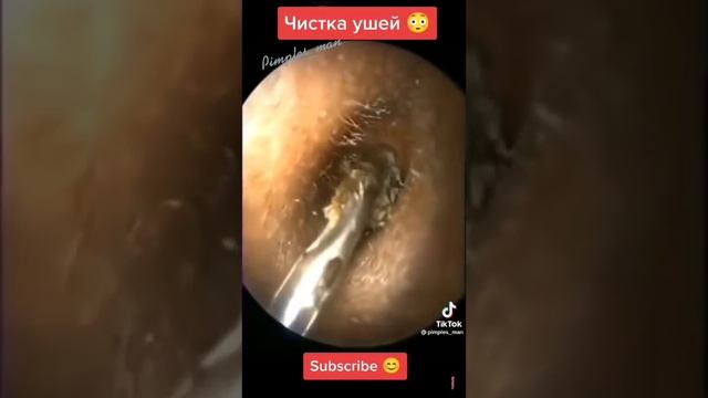Чистка ушей ?