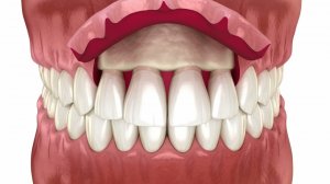 Удлинение фронтальной коронки, эстетическая хирургия