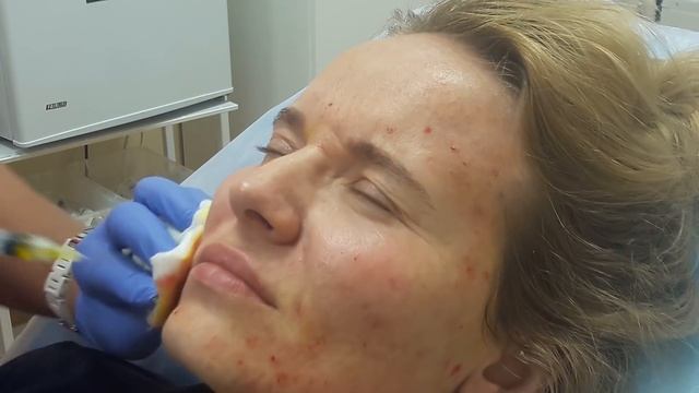 АирисКом студенты учатся: семинар по применению мезопилинга при жирной коже. смотреть онлайн