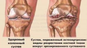 Артроз суставов, артрит суставов - боли в суставах, боль в ногах.