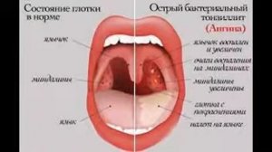 Чем полоскать горло?