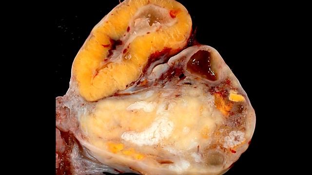 = ЧТО ТАКОЕ КИСТА ЖЕЛТОГО ТЕЛА ЯИЧНИКА? ОПАСНА ЛИ ПРИ БЕРЕМЕННОСТИ = смотреть онлайн