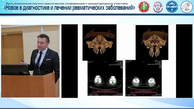 «Остеоартрит - современное состояние проблемы»