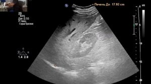 УЗИ ОБП: полип желчного пузыря, киста печени, стеатоз печени, микролиты почек.