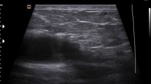 Серома, гематома передней брюшной стенки П\О (22-6-17)