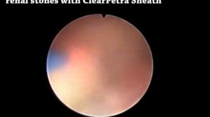 Flexible Ureteroscopic Lithotripsy for Renal Stones with ClearPetra Sheath