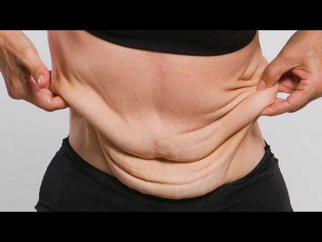 Отвисшая кожа после похудения - что делать? Ответы на вопросы, болталка. смотреть онлайн