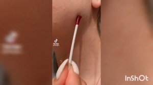 чем мазать ветрянку