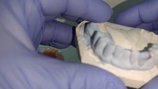 Частично съёмный зубной протез из термопласта смотреть онлайн