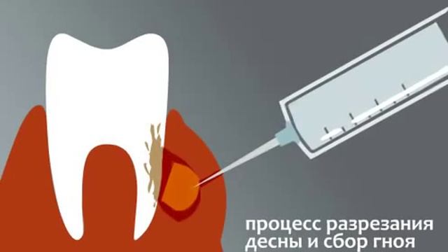 Флюс Лечение флюса смотреть онлайн