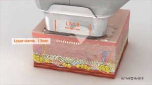 Смас лифтинг и моделирование лица,тела Ultraformer III