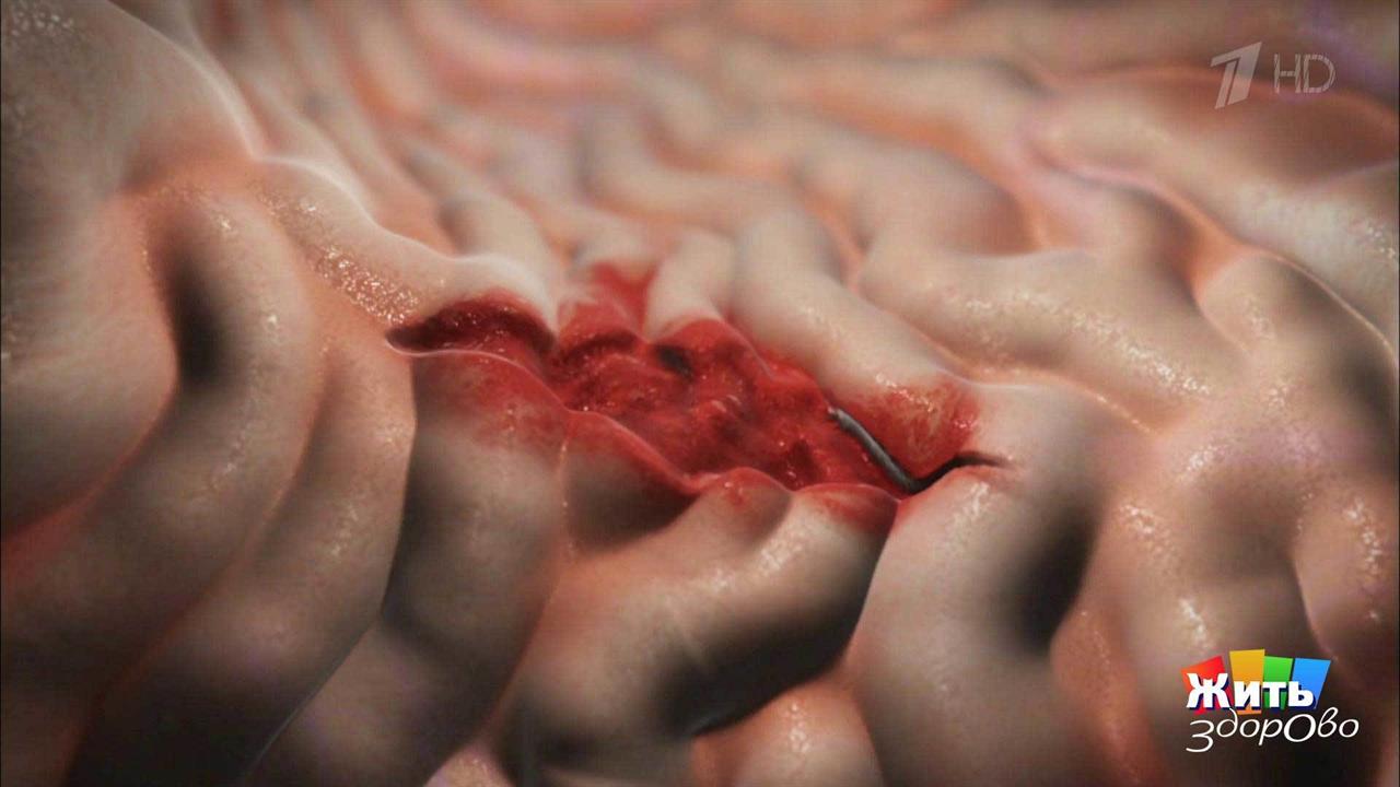 Скрытая угроза. Атрофический гастрит. Жить здорово! Фрагмент выпуска от 17.12.2018