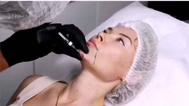 Аугментация подбородка с помощью филлера. Григорьев Сергей Владимирович смотреть онлайн