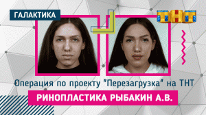Закрытая риносептопластика + блефаропластика: результат | Рыбакин Артур Владимирович