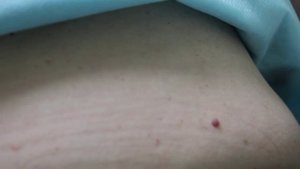 Удаление доброкачественного новообразования