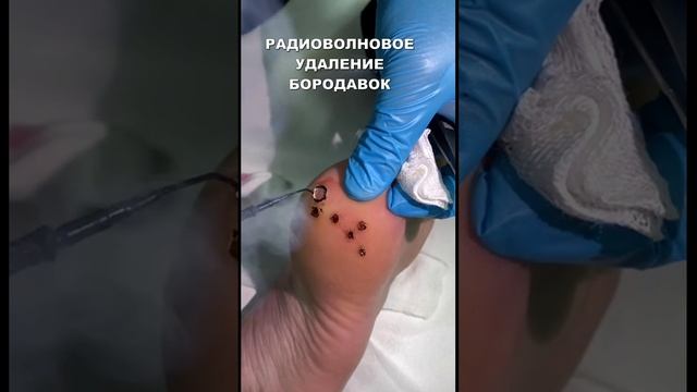 Бородавки пятки. Удаление. смотреть онлайн