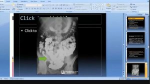 Radiology | GIT Imaging | Part #4 | Large Bowel