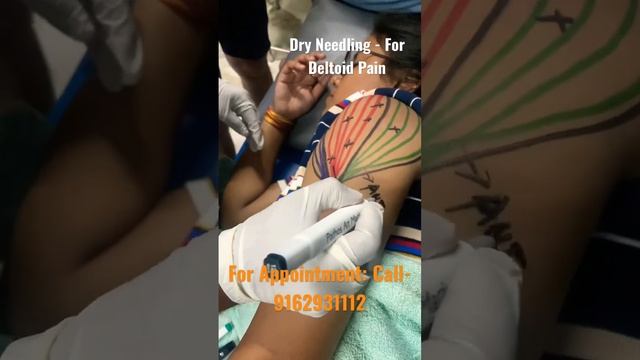 Dry Needling- technique for reliving muscle pain.#myofascialrelease #pain #triggerpoint #viralshort