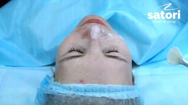 Гликолевыи пилинг в Самаре