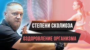 Скажи нет сколиозу! Степени сколиоза позвоночника 1, 2, 3, 4.
