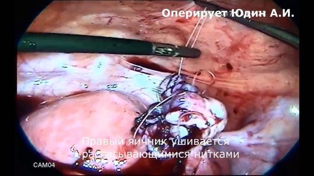 13 Лапароскопия. Двустороннии эндометриоидные кисты яичников