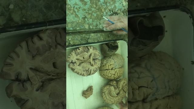 Головной мозг. Белое вещество. Базальные ядра. Оболочки головного мозга смотреть онлайн