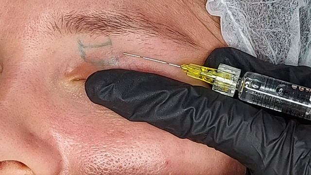 Исправление ассиметриипр.левое веко. Канюля. Предфиллерфрагмент.